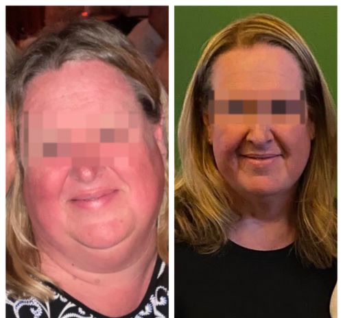 Before and after, a Qua weight loss patient