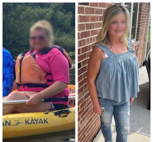 Before and after, a Qua weight loss patient