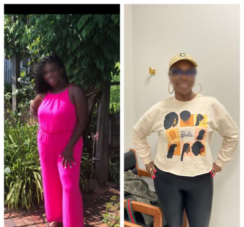 Before and after, a Qua weight loss patient