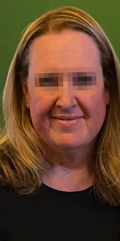 After medical weight loss, a Qua patient, face
