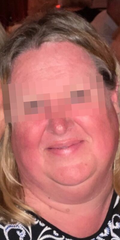 Before medical weight loss, a Qua patient, face